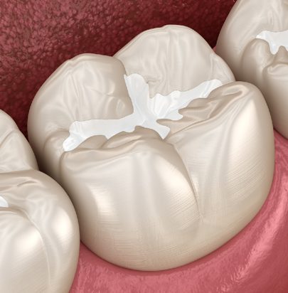 Fillings - Cirencester Dental and Aesthetics