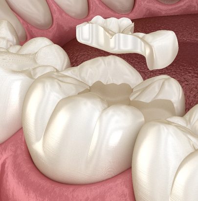 Dental Inlays and Onlays - Cirencester Dental and Aesthetics