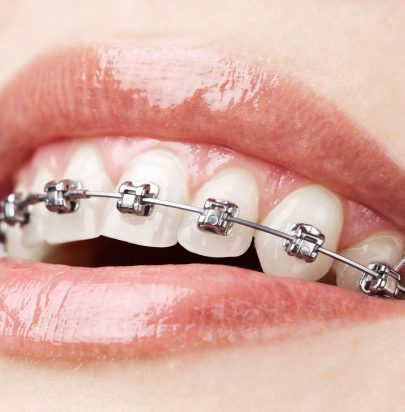 Cosmetic Braces - Cirencester Dental and Aesthetics