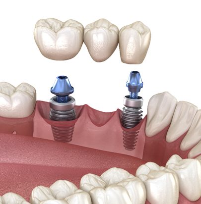 Dental bridges - Cirencester Dental and Aesthetics