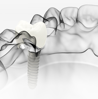 Dental Implants - Cirencester Dental and Aesthetics