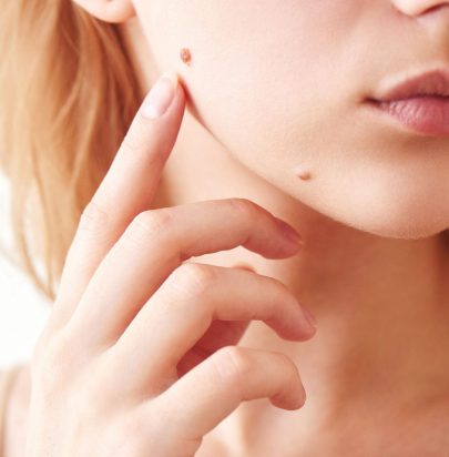 Cosmetic Mole Removal - Cirencester Dental and Aesthetics