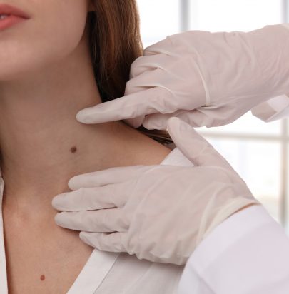 Skin Tag Removal - Cirencester Dental and Aesthetics